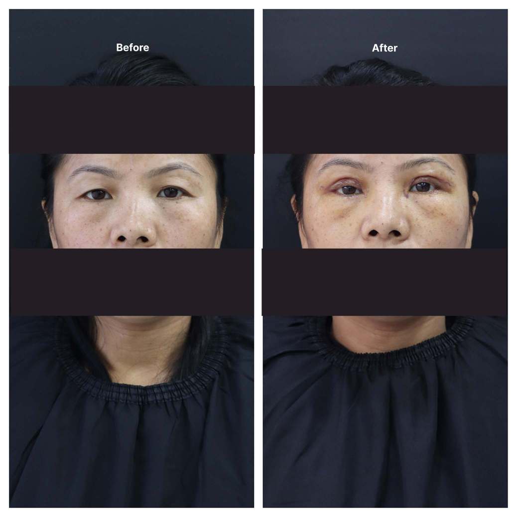 Eyelid Surgery KOQ10